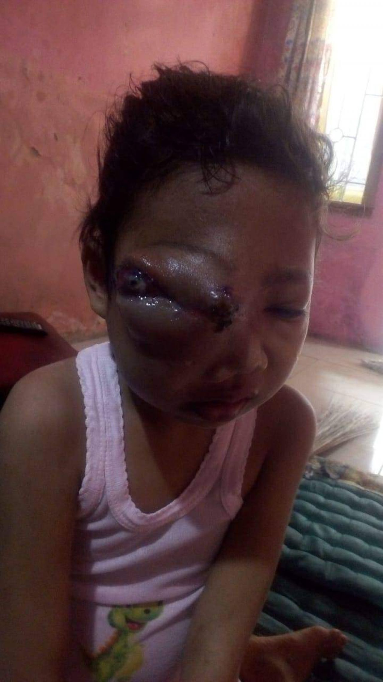 Assyfa Gadis Kecil Penderita Kanker Kelopak Mata Yang Membutuhkan Uluran Tangan