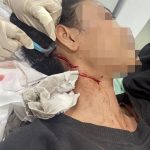 Gagal Rampas Tas, Pria di Tanah Abang Bacok Korban Luka 20 Jahitan